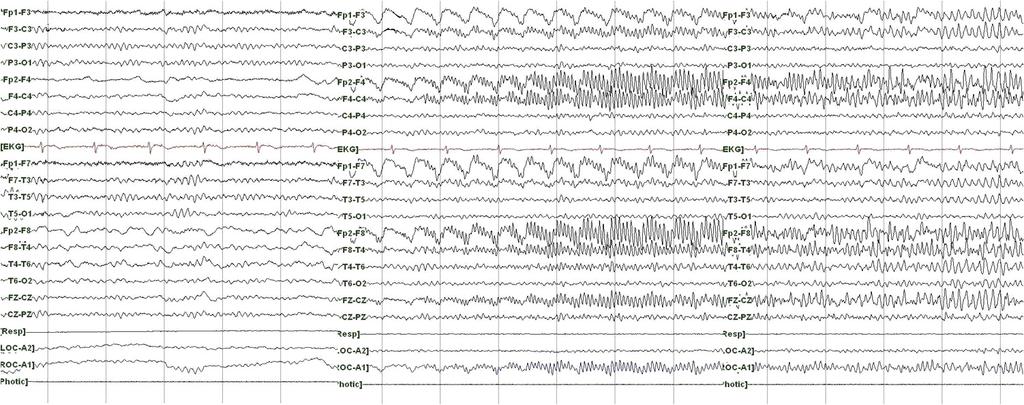 진행다초점백질뇌병증환자에서발생한반복적인복합부분발작 A B C Figure 2. Interictal EEG (A) shows only right fronto-temporal slow activity.