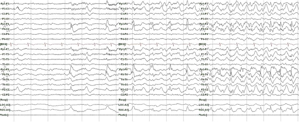 The other ictal EEG (A-C) shows the pattern of periodic lateralized epileptiform discharges (PLEDs) in right frontal areas spreading to adjacent electrodes. 형태를보였다 (Figure 3A-C).