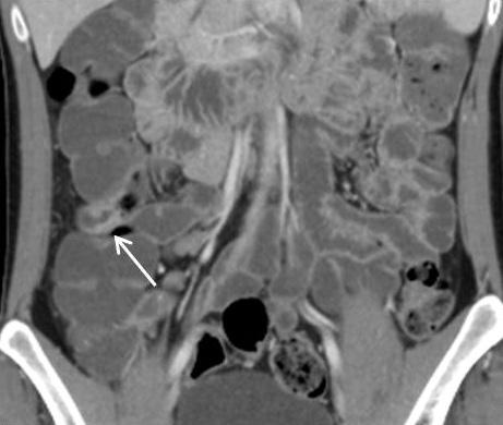 1%) 30 (45.5%) 28 (42.4%) 2 (3.0%) A B Fig. 2. A 19-year-old man with Crohn disease at the ileum.