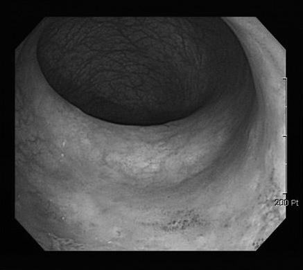 Endoscopy image shows erythematous mucosal change at the ileocecal valve. D.
