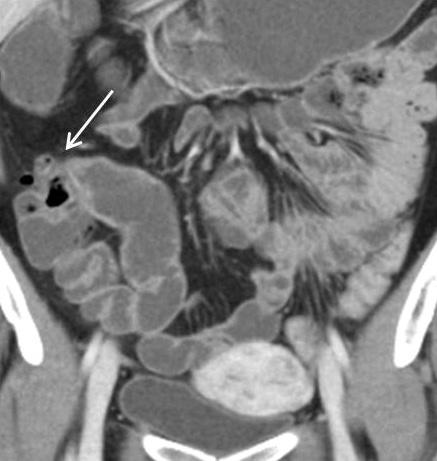CT enterogram shows fibrotic stricture (arrows) at the pelvic ileal loop on coronal image, which was missed on axial image.