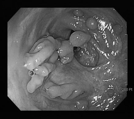 coronal images, which was missed on axial image. D. Endoscopy image shows numerous pseudopolyp and cecal deformity.