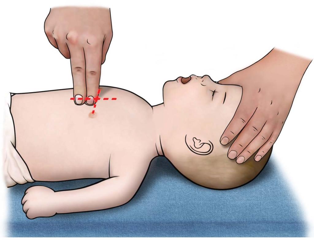 그림 5-3 영아의가슴압박 소아의경우흉골아래 1/2 부분을, 한손혹은두손의손꿈치를이용하여환자흉곽전후직경의적어도 1/3 깊이 ( 약 4-5cm) 를압박하여야한다.