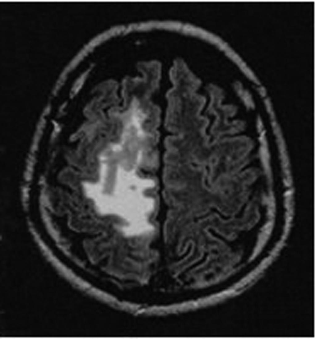 Kong Y Figure 9. Brain image of neurosparganosis.