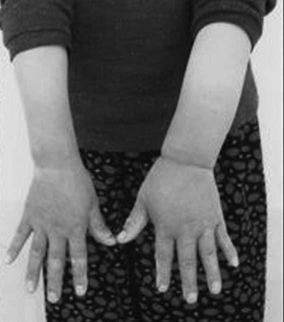 part. Lymph spaces are obliterated by lymphedema.
