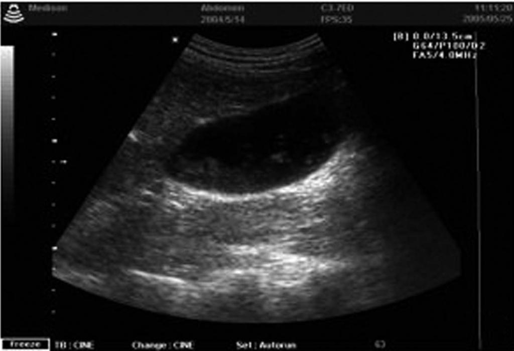 Kong Y A B Figure 5. Sonograms of patients with Clonorchis sinensis. [Courtesy of Dr. DI Choi (Sungkyunkwan University) and Dr.