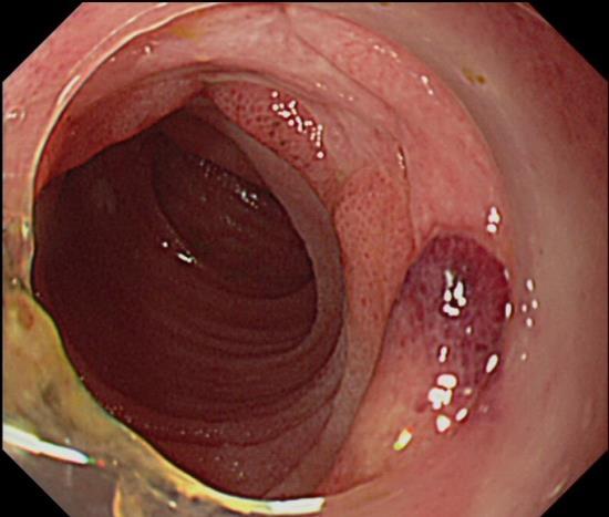 ulceration Recurrent oral aphthous ulcerations