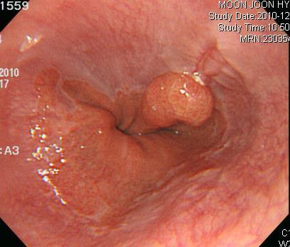 Tbc Esophagitis mimicking Eso