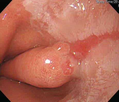 diagnosis from esophageal
