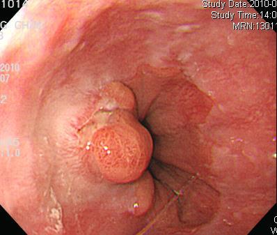 esophagus Endoscopic Differential Diagnosis - Not clear cut Biopsy is essential!