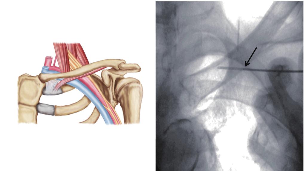 A Costoclavicular ligament Subclavius muscle B Sternum Axillary vein Figure 3. The technique of subclavian vein puncture. Anatomical orientation for subclavian vein puncture.
