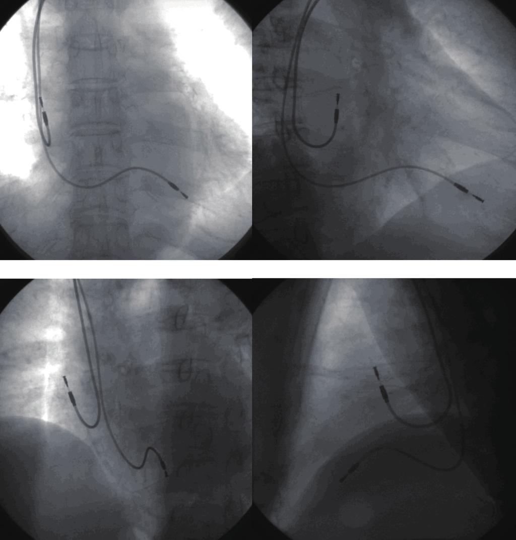 A B Main Topic Reviews C D Figure 4. Fluoroscopic image of pacemaker leads. Anteroposterior view (A). Right anterior oblique view (B). Left anterior oblique view (C). Left lateral view (D).