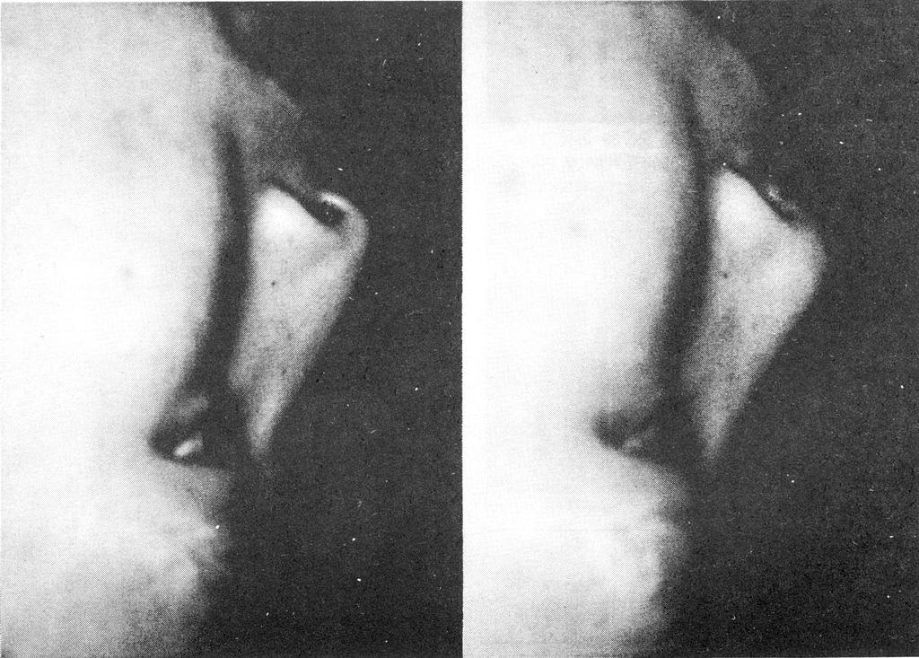 Korean J Otolaryngol 40 8, August 1997 Fig. 3. A case showing overrotation of tip. a.