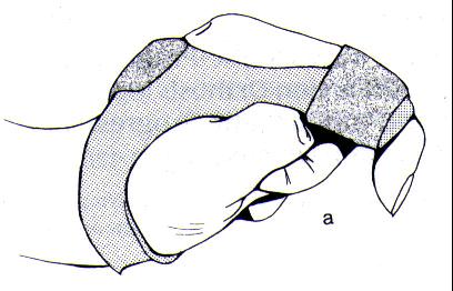 Circumferential hand-based static MCP- PIP flexion blocking orthosis
