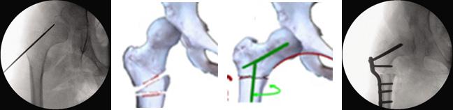 그림 2: 대퇴골내반감염절골술시행과정 보다효율적인보행및자세유지를할수있도록하기위해시행되는 5가지하지골교정절골술은모두대퇴골또는경골의특정부위에서절골하여일부를제거하거나회전및이동시키는방식이다.