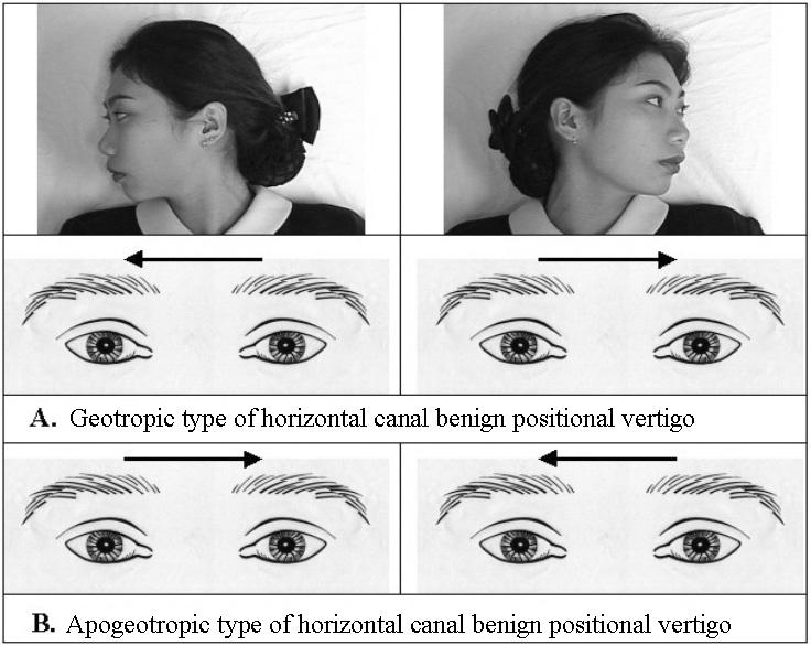 김지수 Figure 12. Two types of positional nystagmus induced by head turning while lying down in horizontal canal type of benign positional vertigo.