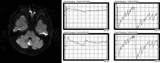 안진 Figure 14. Positional downbeating nystagmus during central head hanging in uvulonodular infarction. Figure 15. Perverted head shaking nystagmus.