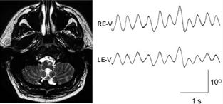 김지수 Figure 8. Oculopalatal tremor. Symmetrical vertical pendular nystagmus is observed with unilateral olivary hypertrophy (arrow).