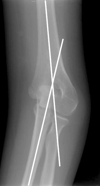 Results of Supracondylar Lateral Closing Wedge Osteotomy Last Index Parameter Preoperative p value* follow-up side Range of motion ( o ) 136.9 139.2 0.050 140.0 Humero-ulnar angle ( o ) 17.4 9.8 0.