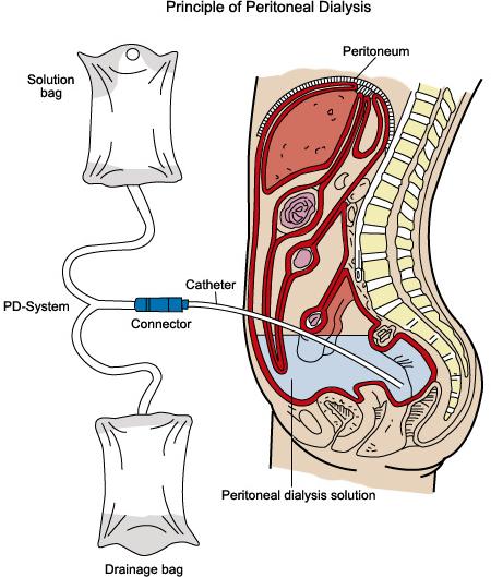 Treatment: Peritoneal dialysis Semipermeable membrane Catheter inserted through abdominal wall into peritoneal