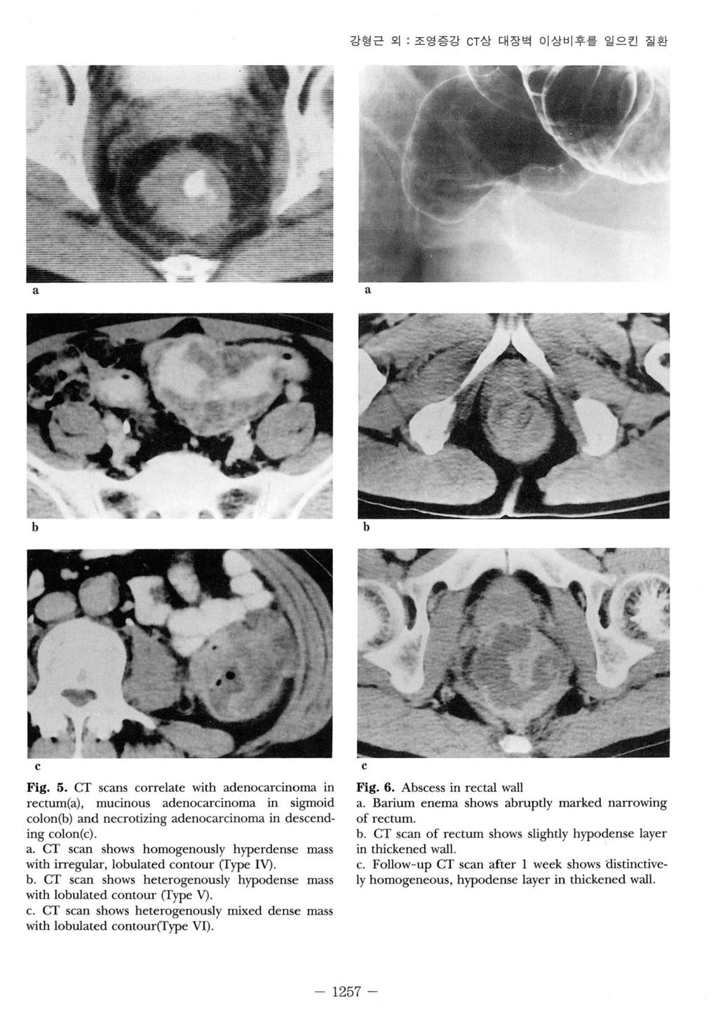 강형근외 : 조영증강 CT 상대장벅이상비후를일으킨질환 b c Fig. 5. CT scns correlte with denocrcinom in rectum(), mucinous denocrcinom in sigmoid colon(b) nd necrotizing denocrcinom in descending colon(c).. CT scp.