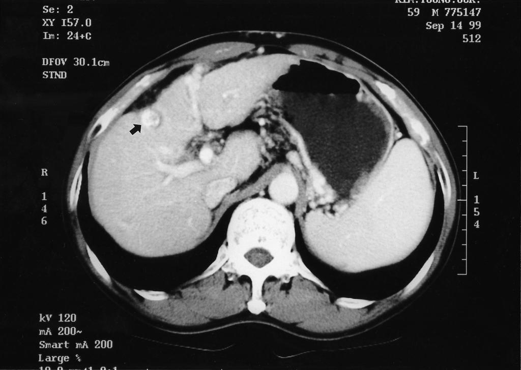 12. TACE 2 373 Figure 5. CT scan obtained after T ACE show s dense lipiodol- laden lesion in segment 4 of the liver. Figure 6.