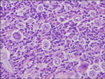 (B) Cellular nodule of the Nodular sclerosis shows numerous lacunar cells. (C) CD30 immunostaing in the RS cells.