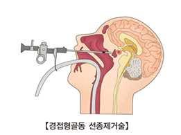 2. 후엽의장애 3) 뇌하수체절제술을받은환자의간호 (1) 수술방법 : 접형골을통해접근, 코를통해수술 (2) 간호수술전 : 환자와가족에게심리적지지와편안함제공, 신경계사정 수술후 1 부신피질부전, 갑상샘기능저하가오는지관찰 2 콧물이흐르면, CSF 일수있으므로검사실로보냄 3