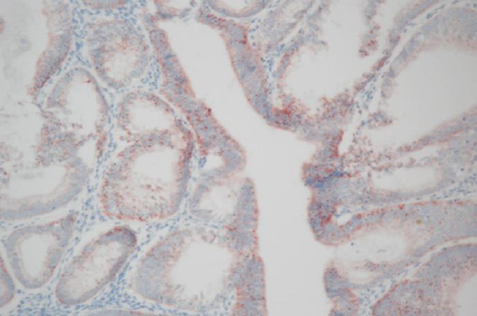 자궁내막암의 예후인자로서의 MMP-2,-9, TIMP-1,-2 발현 Fig. 3. Endometrial tumor glands show diffuse immunostaining to TIMP-1 in tumor cell ( 200, TIMP-1). Fig. 4.