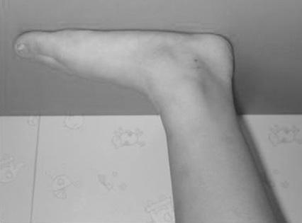 110 Sun Young Joo and Jung Ryul Kim A B Figure 1. (A) Clinical photograph of the foot demonstrating flexible flatfoot deformity.
