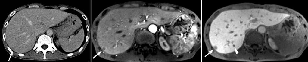 High field strength magnetic resonance imaging of abdominal diseases A B C Figure 3.
