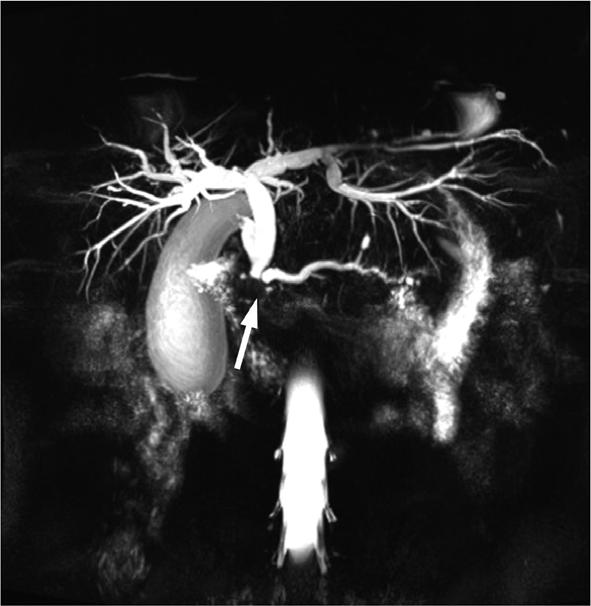 transplantation demonstrates excellent contrast-to-noise ratio and detailed vascular anatomy. Figure 5.