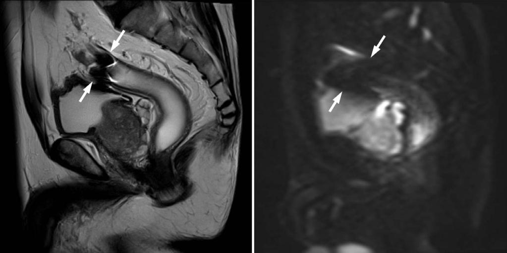 High field strength magnetic resonance imaging of abdominal diseases A B Figure 6. Increased susceptibility artifacts at 3 tesla in a 64-year-old man with proximal rectal cancer.