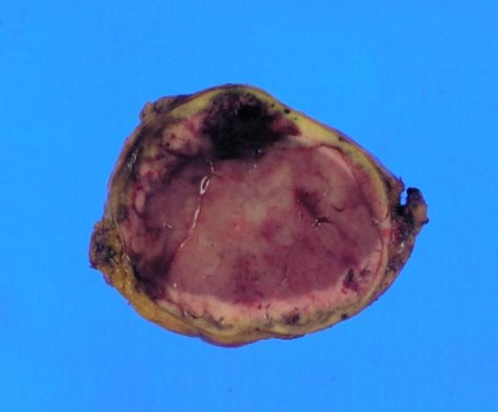 병리조직검사결과종양은타원형모양으로크기 5 4 3.5 cm, 무게 36 g이었고외부표면은어두운노란색을띤캡슐에잘싸여져있었으며종양의단면은검붉은색의수질과피질로나뉘어있었다 (Fig. 3A).