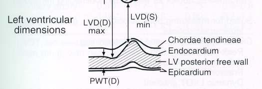 M mode : LV mid level Parasternal Short Axis