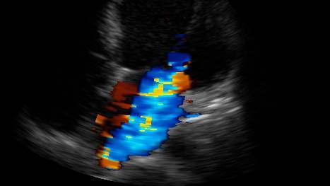 Color Doppler 로측정한 MR 의중증도 Color Flow Mapping +1 =