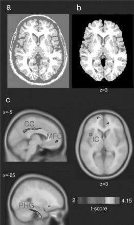 이연아 : 꾀병으로오해받는외로운통증 Structural changes Accelerated brain gray matter loss in FMS patients Kuchinad A, et al.