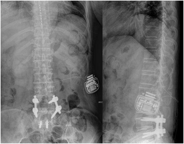 Spinal Cord Stimulation for Control of Chronic Pain 87 Fig. 1. These pictures show postoperative finding of spinal cord stimulation.