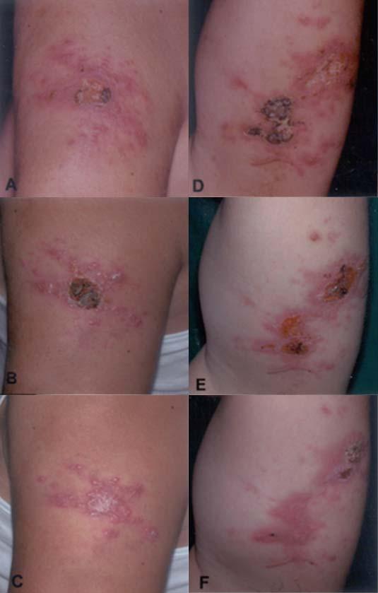 Outer side of the left upper arm before treatment (A) was improved 5 weeks later (B) and left scar after 11 weeks (C).