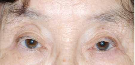 Periorbital changes with aging 의학강좌 Figure 1. Photograph of a 74-year-old woman with high placement of multiple creases and hollow superior sulcus. 1. 윗눈꺼풀의변화 눈꺼풀의변화 나이가들어감에따라눈썹이내려오고눈꺼풀피부가늘 어지며늘어진피부가눈을가려시야가줄어들게되며눈꺼풀이무거워보이게된다 [1].