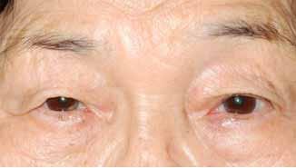 Choung HK 에따라눈꺼풀올림근널힘줄을이루는콜라겐다발의미세허혈과눈꺼풀부종, 지속적인눈깜박임등의기계적스트레스에의한늘어짐, 그리고콜라겐섬유의생성과파괴에관여하는호르몬및사이토카인의불균형등이널힘줄을약화시키고나이가들면서조금식진행하는것으로알려져있다 [8-10].
