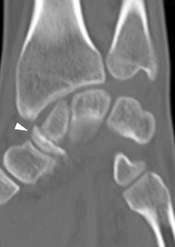 radiographs showed distal scaphoid