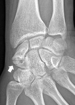 (A, B) A preoperative plain radiographs showed distal scaphoid nonunion (arrow).