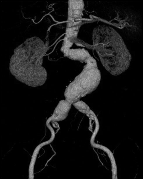 Volume rendering image shows infrarenal abdominal aortic aneurysm (sac diameter: 42 mm) with aneurysmal dilatation of left common iliac artery