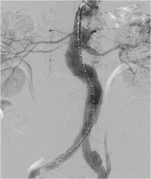 Volume rendering image shows infrarenal abdominal aortic aneurysm (sac diameter: 46 mm) with aneurysmal dilatation of both common iliac arteries.