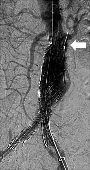 After 1 month, there was no complication on follow up abdomen CTA. Note.-CTA = CT angiography Table 5.