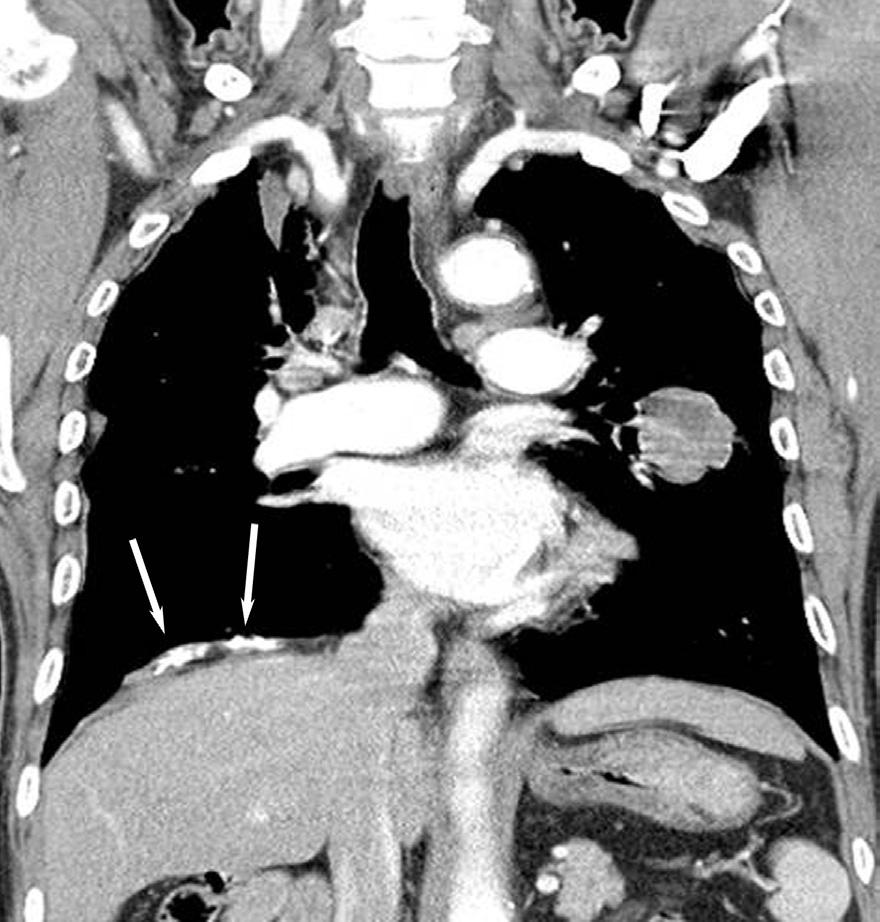 Chest PA (A) and lateral (B) views show a mass in the left middle lung zone.