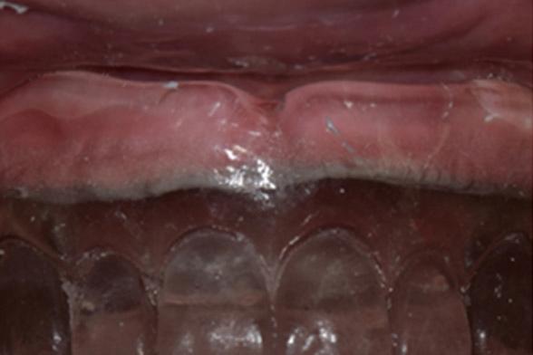Fig. 7. Check of the pressure areas in the anterior maxilla. Fig. 8. Functional impression with tissue conditioner. A B Fig. 9. Intraoral (A) and extraoral (B) photos after placement of prosthesis.