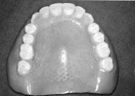 abutment for overdenture in the upper jaw Fig. 2.