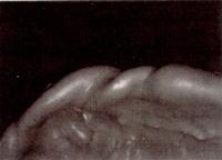 11 12 사진 14 : 최종인상체의변연부위. 사진 11, 12 : 하악의최종인상체. Mohyoid muscle 의수축이잘인기되어있다.